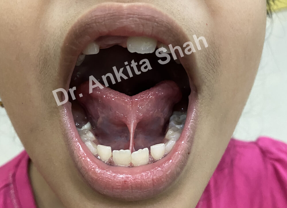 tissue between the tongue and floor