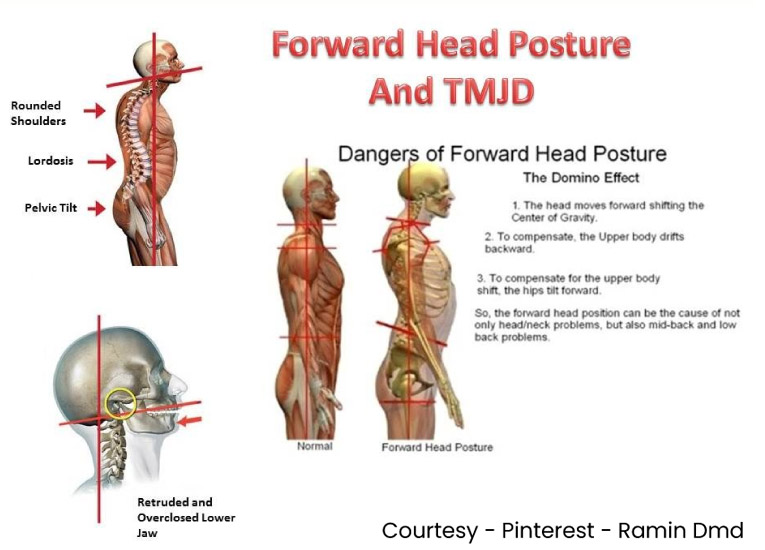 Forward Head Posture and TMJD