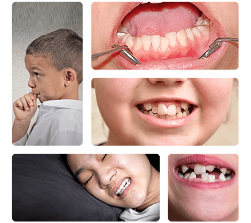SIGNS-THAT-INDICATE-A-CHILD-REQUIRES-BRACES