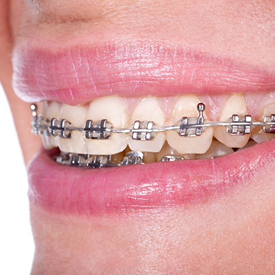 Regular or self-ligating braces